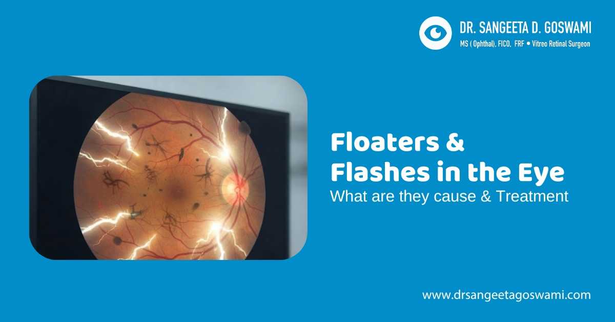 Floaters and Flashes in the Eye: What Are Their Causes and Treatments?