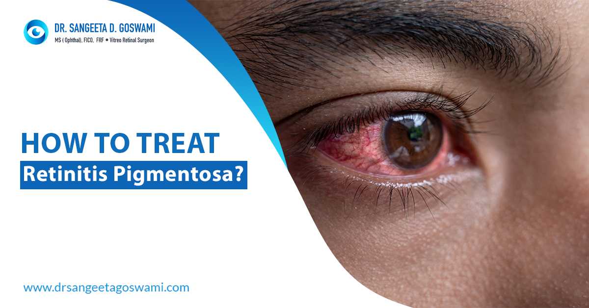 Best Retina Specialist in Siliguri