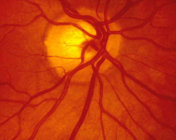 Central Retinal Vein Occlusion