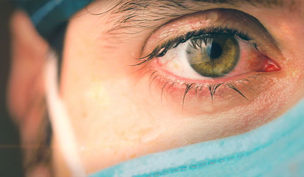 Corneal Abrasion