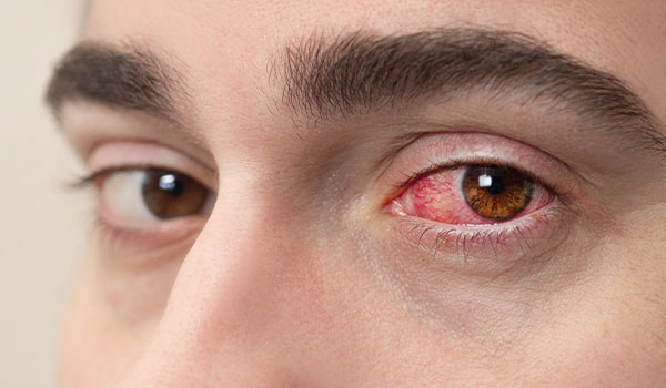 Subconjunctival Hemorrhage